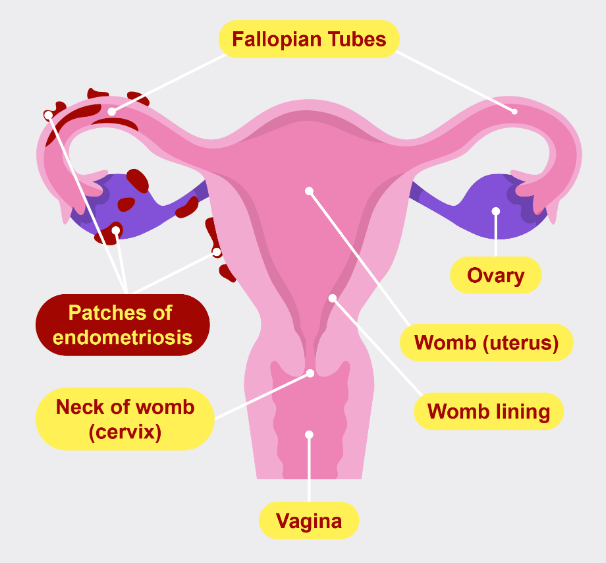 Diagram showing endometriosis patches cells in the fallopian tubes