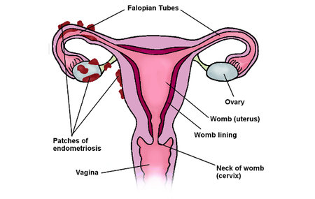 An image of a uterus showing endometriosis adhesions