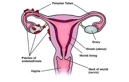 What is Endometriosis and its key Symptoms & Causes?