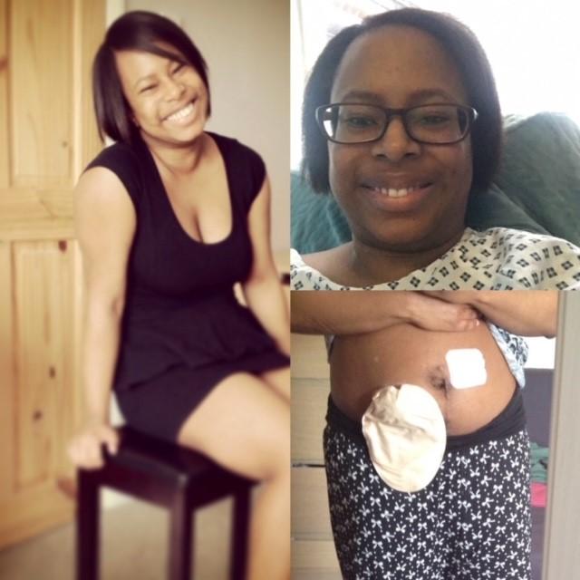 Photo collage of endometriosis case study Nadine